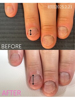 シーグラス(SeaGlass)/噛み爪育成+ハンドマッサージ付