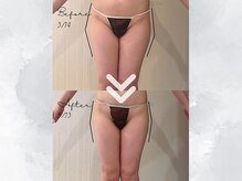 サイバーエステ 宇都宮店/外ももの横ハリ、ご相談ください