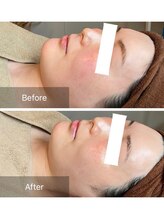 サロン グリッター 新宿(Salon GLITTER)/【肌質改善】ビフォーアフター