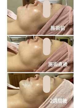エステティックサロン アールグレー/Neoリフトフェイシャル1回変化
