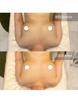 ルメール(Lemaile)/デコルテ 削げ 痩身 肩こり