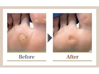 巻き爪補正店 越谷店/ウオノメ・タコケア