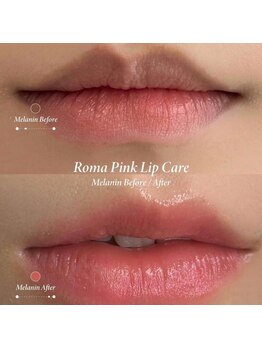 韓国肌管理yeoun【ヨウン】ROMAPINK/黒ずみ/毛穴/プラピール/ララピール福岡天神/ローマピンク福岡/メラニンケア