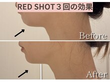エトワール(etoile)/RED SHOTで顎下スッキリ!