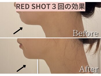 エトワール(etoile)/RED SHOTで顎下スッキリ!