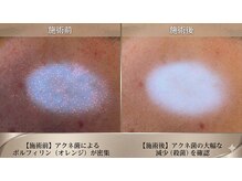 エクラ(eclat)の雰囲気（目に見えないニキビ菌を殺菌。肌本来の清潔さを取り戻す。）