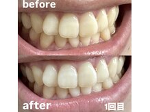 マミー(mammy)/ネイルと一緒にホワイトニングも