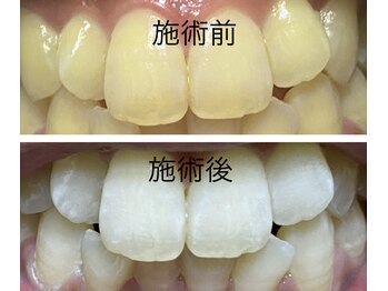 チェリーブロッサム(A CHERRY BLOSSOM)/デンタルホワイトニング