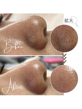 ボータン 恵(Beau Temps)/毛穴ケア/毛穴洗浄　【施術例】