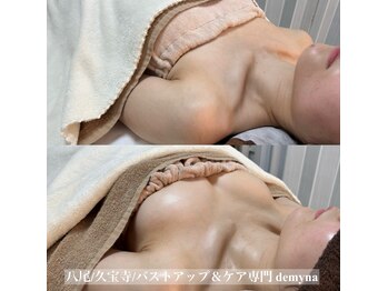 デミーナ(Demyna)/【バストアップ】症例 育乳