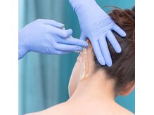 うなじ シュガーリング脱毛について基本は産毛の脱毛をします