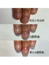 マニュコクーン(ManuCocoon)/爪育成　深爪　巻き爪　大阪市