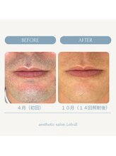 レブル(Lebull)/ヒゲ脱毛