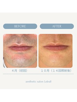 レブル(Lebull)/ヒゲ脱毛