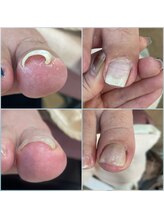 【巻き爪、変形爪ケア】トラブルフットケア