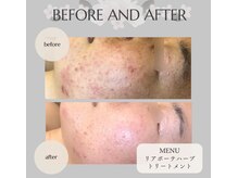 KANコルギセラピー 群馬高崎店の雰囲気（リアボーテハーブはヒト幹細胞の力でハリ肌へ導きます。剥離なし）