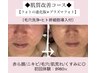 肌質改善コースプラズマフォト×毛穴洗浄×ヒト幹導入★赤み/美白/ニキビケア