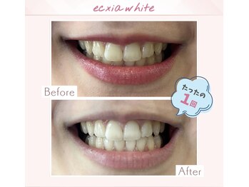 エクシアホワイトニング 調布店/40代女性会員様/1回目