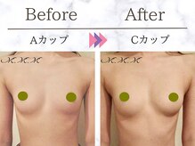 エムエムエム 表参道Luxeサロン(M.M.M)/【バストアップ例】　A→Cカップ