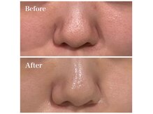 ウルル 上野店(ULULU)の雰囲気（毛穴詰まりにはスチーマー付き毛穴洗浄でお掃除☆）