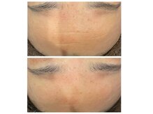 エクリュ(ecru)の雰囲気（1回のハンドテクニックでシワ改善）