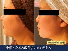 エヴァーグレース 川崎店/韓国美容で話題のレモンボトル