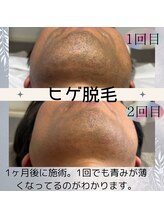 ヒダマリ 新屋敷店(Hidamari)/もはや常識？男性ヒゲ脱毛