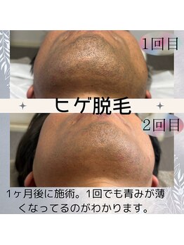 ヒダマリ 新屋敷店(Hidamari)/もはや常識？男性ヒゲ脱毛