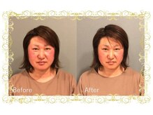 レメディ/美容鍼コース