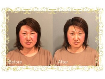 レメディ/美容鍼コース