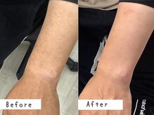 セルフメイド 高崎店(SELFMADE)/ウデ脱毛10回