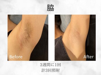 ベル(Belle)/レディースワキ脱毛