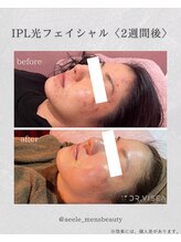 エール(AEELE)/■IPL光フェイシャル■