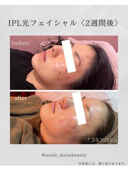 エール(AEELE)/■IPL光フェイシャル■