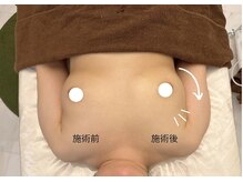 ルメール(Lemaile)/左右差　マッサージ　リンパ