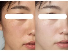 韓国美容で注目のララピール毛穴・ニキビケア・シミシワケア