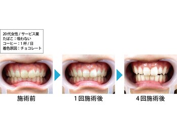 ルミナ(LUMINA)/ホワイトニングで笑顔で接客!