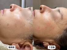 エングラッシー(en glassy)/BEFORE　AFTER　最新シミ回収