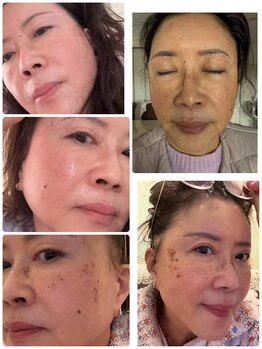 東洋経絡エステ アンド リラクゼーション/シミケア11日間の変化