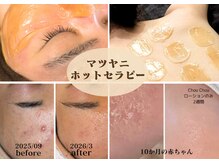 キレイエ(kire-ie)の雰囲気（マツヤニホットセラピーは肌の循環を整えることで美肌を取り戻す）