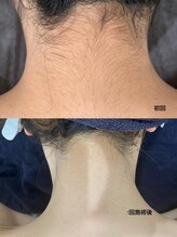 脱毛専門サロン エリクサー(Elixir)/Before After