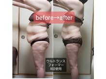 ラブリエ(Labriller)/トリプルアタック痩身