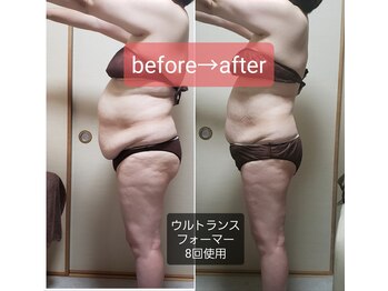 ラブリエ(Labriller)/トリプルアタック痩身