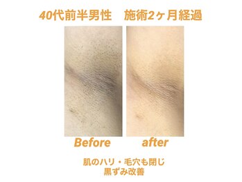 ビカム(become)/脇脱毛！