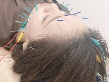 ハリナチュレ 梅田店(HARINATURE)の写真/【大阪/梅田◇美容鍼】美容鍼×美容小顔整体サロン♪フェイスアップ美容鍼でお顔・お肌のお悩みを解決！