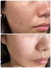 エタニティ 西宮店(Eternity)/韓国ハーブピーリング