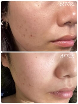 エタニティ 西宮店(Eternity)/韓国ハーブピーリング