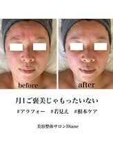 ディアンヌ(Diane)/40代小顔/目元/フェイスライン