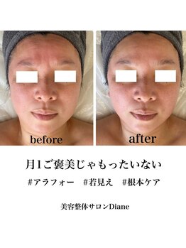 ディアンヌ(Diane)/40代小顔/目元/フェイスライン