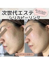 リモア(REMORE.)/肌改善お任せください！